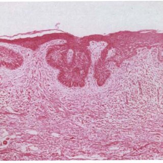 Basal cell carcinoma diagnosis pdf