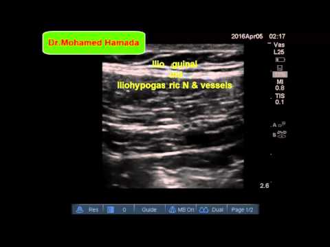 Ultrasound guided ilioinguinal nerve block