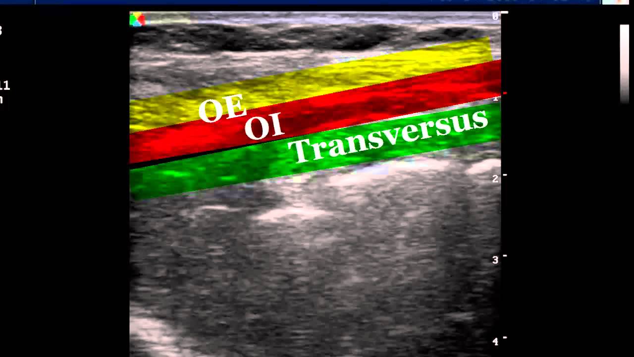 Ultrasound guided ilioinguinal nerve block